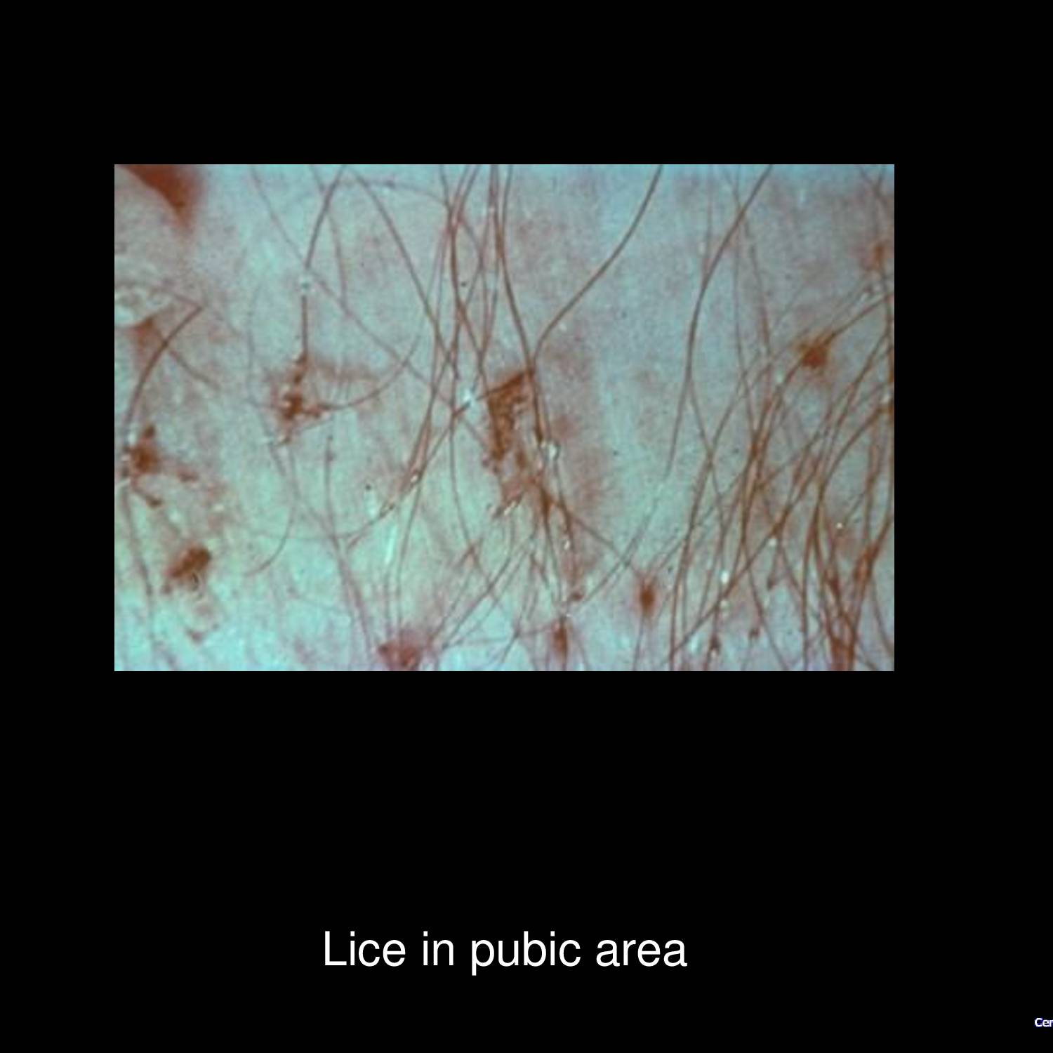 Scabies burrows on interdigital web space showing characteristic thin wavy grayish lines caused by Sarcoptes scabiei mite infestation